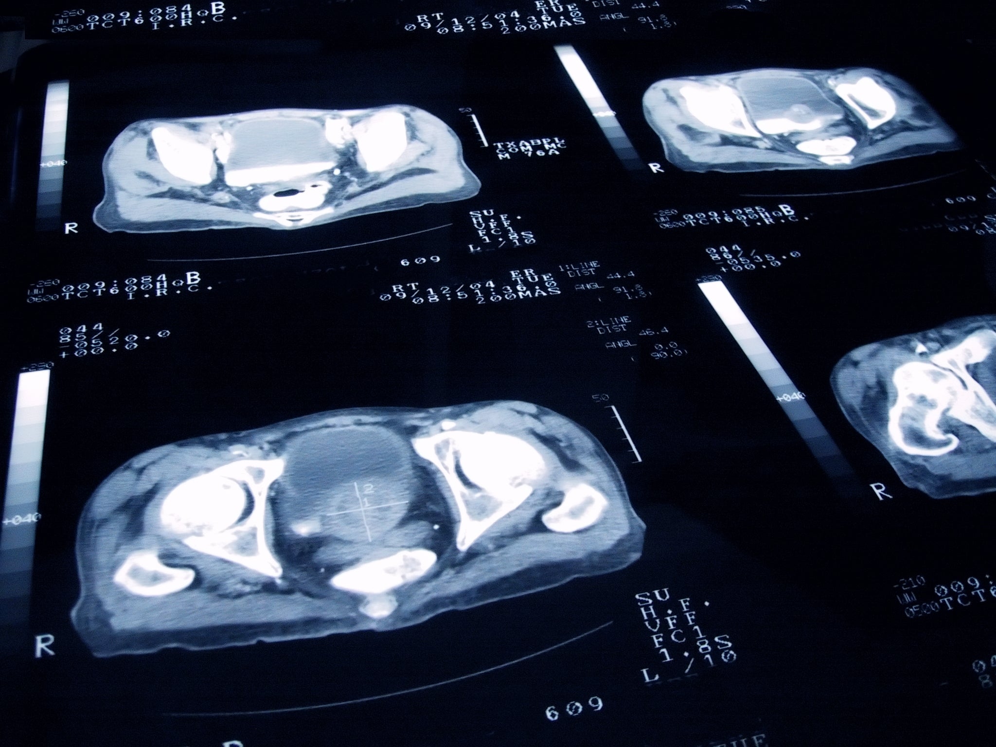 Cancer types studied included bladder, breast, cervical, bowel, kidney, liver and bile-duct, lung, ovarian, pancreatic, prostate, skin and blood cancers such as leukaemia