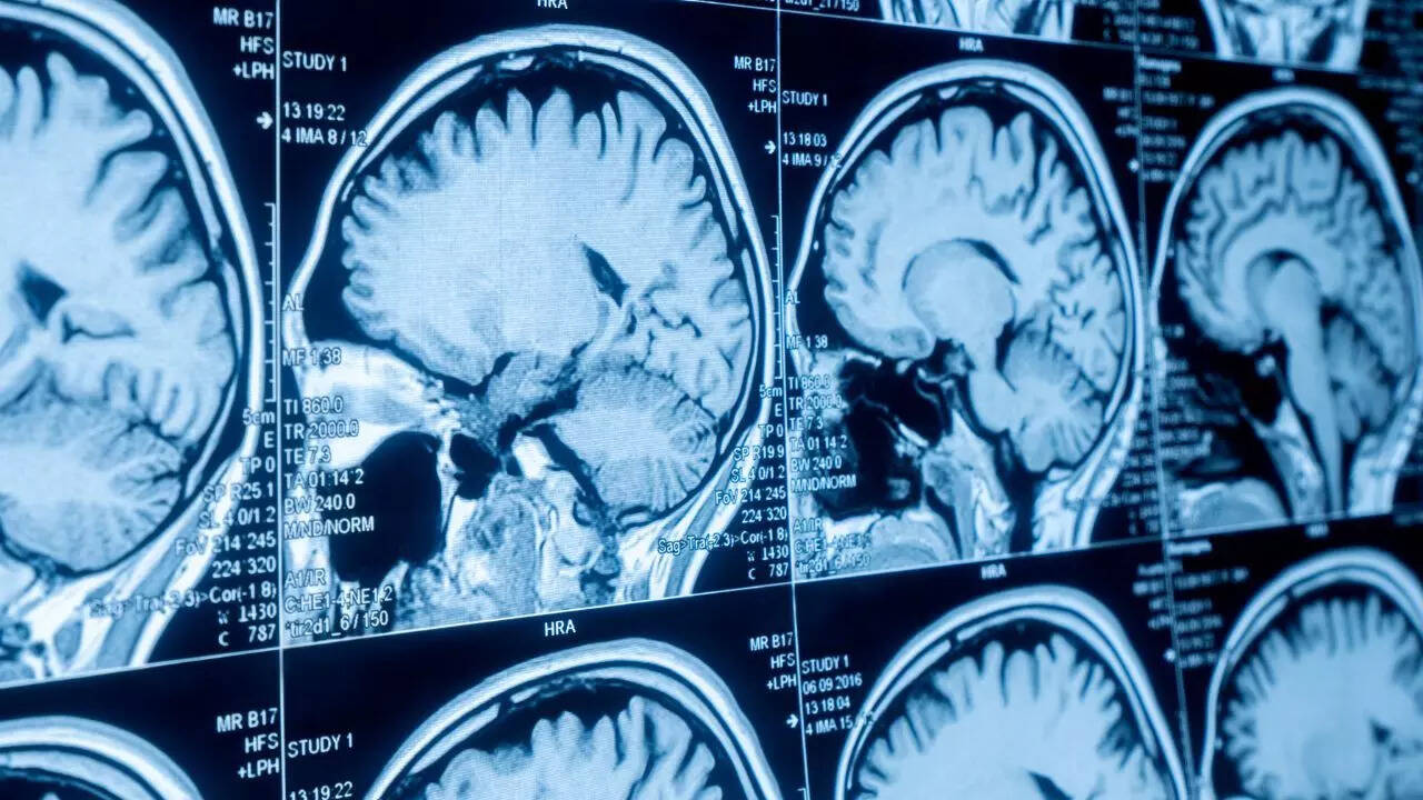 Multiple surgeries and MRI scans uncover fast-growing malignant brain tumour
